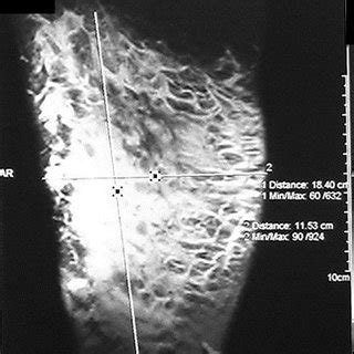 PDF Liposarcome myxoide sous cutané