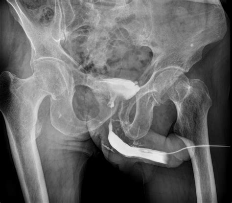 Venous Intravasation In Retrograde Urethrography Image Radiopaedia Org