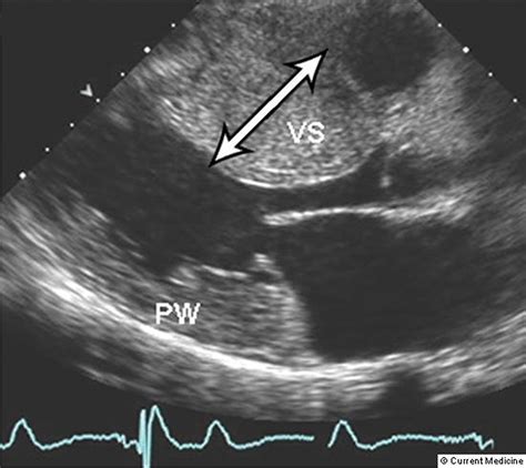 Hypertrophic Cardiomyopathy Hypertrophic Cardiomyopathy Msd Manual