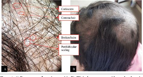 Figure 1 From Importance Of Dermoscopy In Diagnosis Of Tinea Capitis An Evidence Based Case