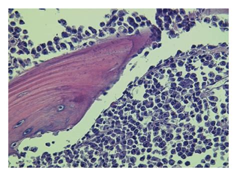 A B Two Massive Extra Axial Tissue Lesions Right 35 Cm In The