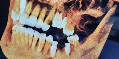 D Cbct Imaging And Its Impact On Dental Implant Procedures Mcomie