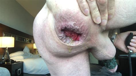 Anal Stretching Gaping Inflating Butt Plug Gay Porn F Xhamster