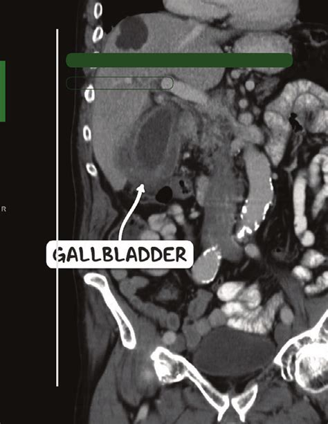 Chronic Cholecystitis Osmosis