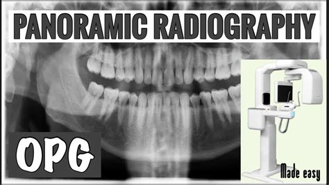 Panoramic Radiography Ii Opg Ii Extraoral Radiography Ii Oral Radiology