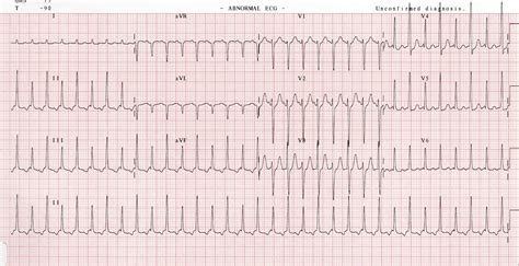 Electrical: Electrical Alternans