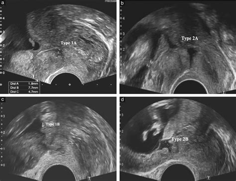 Lower Uterine Segment Scar Assessment At 1114 Weeks Gestation To