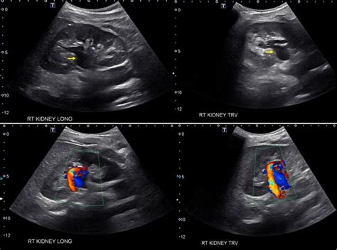 The Ultrasound Mimics of Hydronephrosis - Renal Fellow Network