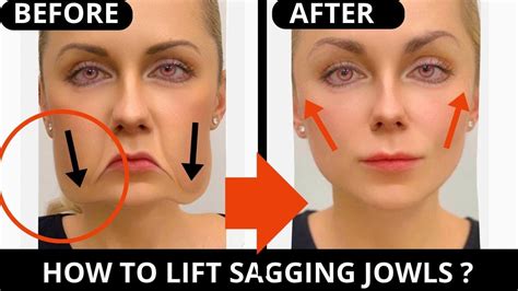 Face Lifting Exercises For Jowls And Laugh Lines Nasolabial Folds