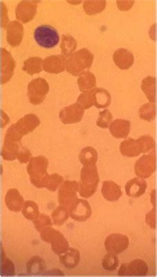 Peripheral Smear Reveals Rouleaux Formation And Diamond Shaped Blanched