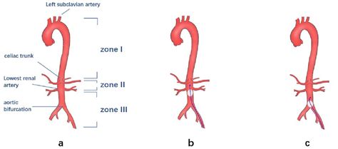 Pdf Location Of Resuscitative Endovascular Balloon Occlusion Of The