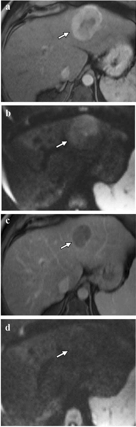 Segment 4 Li Rads 5 Observation White Arrow Exhibits A Aphe And B Download Scientific Diagram