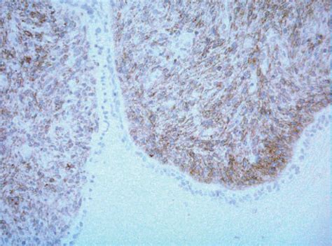 Figure 2 From Uterine Sarcoma A Rare Cause Of Uterine Inversion