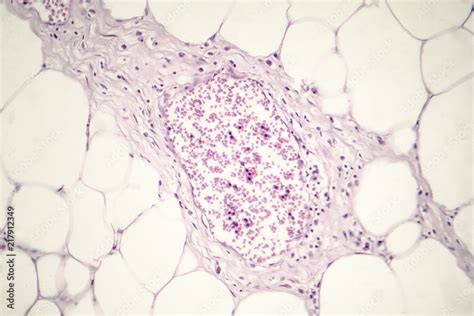 Lipoma Benign Growth Of Fatty Tissue Light Micrograph Photo Under