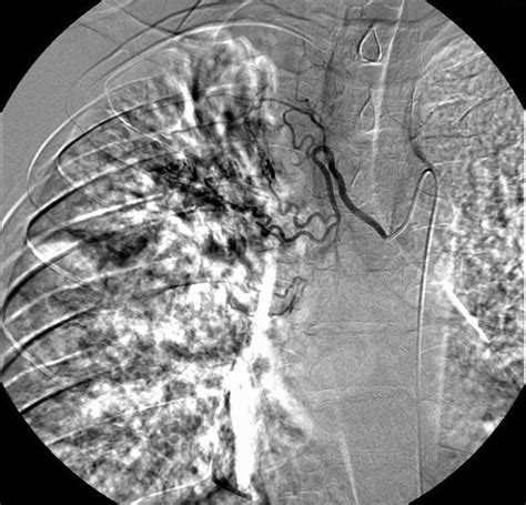 CT Guided Percutaneous Embolization Of A Rasmussen Aneurysm With