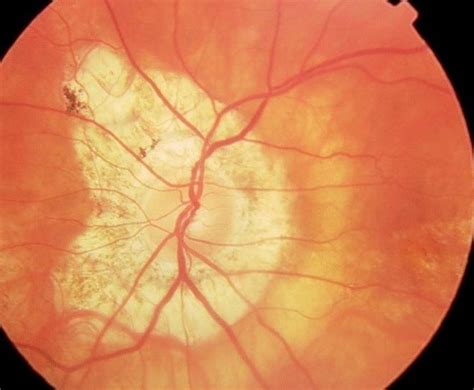 The Relationship Between Myopia And Glaucoma Review Of Presbyopia