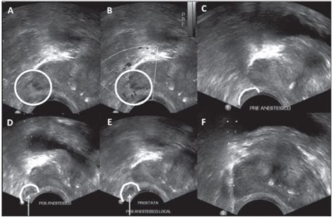Ultrassonografia De Próstata Em Guaianases Biopsia Para Detectar