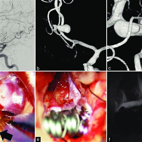 A Lateral View Of Left Internal Carotid Artery Angiogram B