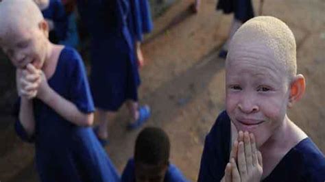 La Idea Revolucionaria Que Podría Acabar Con El Estigma De Los Albinos En África