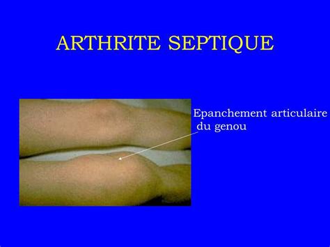 Arthrites Septiques Infectieuses Ppt Video Online T L Charger