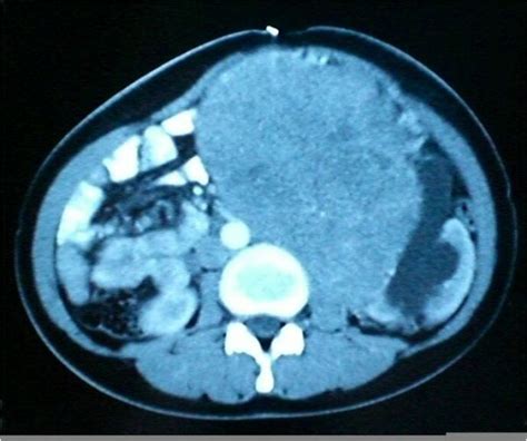 A Contrast Enhanced Axial Computed Tomography Image Shows A Huge