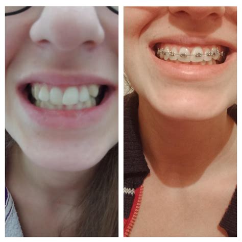 2.5 months in! I didn't believe I would see progress this soon even