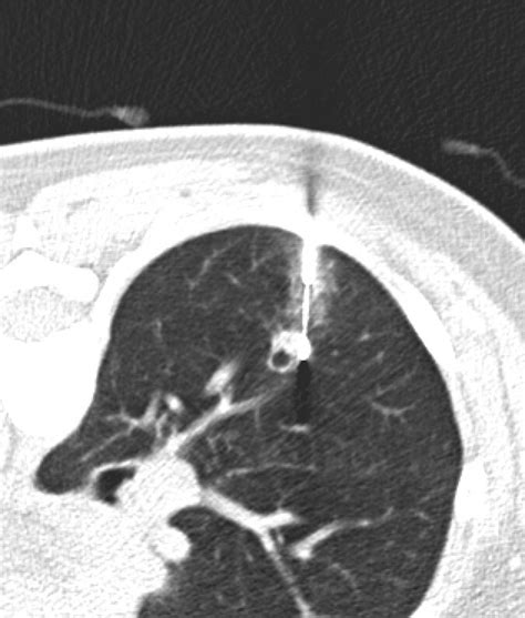 Diagnostic Accuracy Of Ct Guided Core Needle Biopsy For Thin Walled