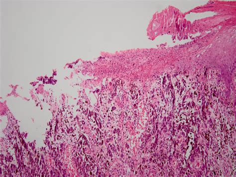 Malignant Melanoma Histology