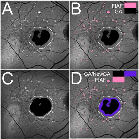 Patient Od Year Progression Of Geographic Atrophy In Y O Male