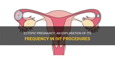 Ectopic Pregnancy An Exploration Of Its Frequency In Ivf Procedures