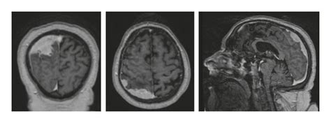 MRI showing right solid extra-axial parieto-occipital lesion with ...