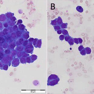 Micrographs Of A Fineneedleaspirate Cytology Sample Of A Seminoma In