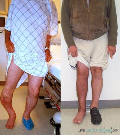 Before After Photos Limb Lengthening Knock Knees Correction