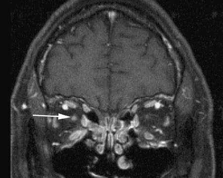 Ischemic optic neuropathy | Applied Radiology