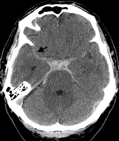 Inter And Intraobserver Agreement In Ct Characterization Of