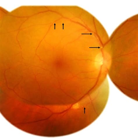 Pdf Kyrieleis Arteritis Associated With Toxoplasmic Retinochoroiditis