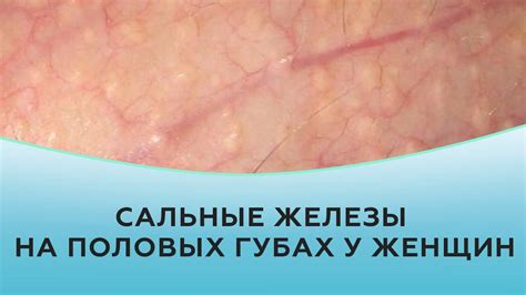 Как выглядят папилломы на половых губах фото