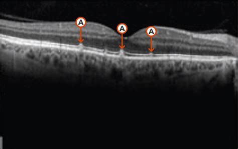 Understanding Geographic Atrophy Ga