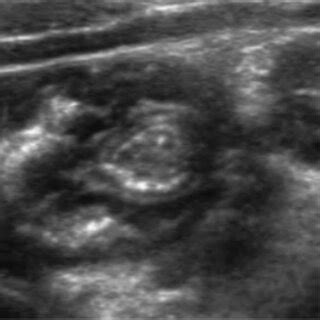 (A) A chest radiograph showing bilateral perihilar interstitial ...