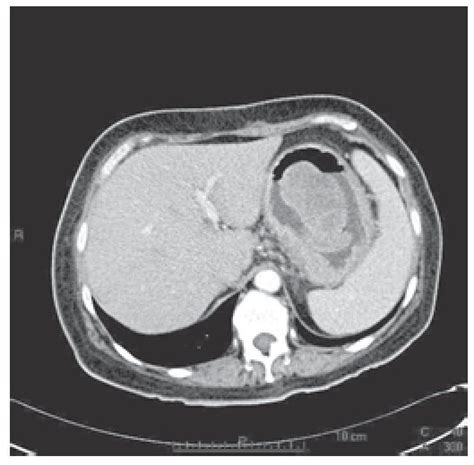 Pólipo fibroide inflamatorio gástrico gigante Reporte de caso y