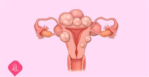 Miomas Uterinos E A Classifica O Figo Juan Pablo Cazajus The