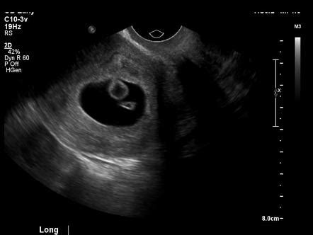 Chorionic bump | Radiology Reference Article | Radiopaedia.org