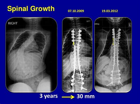 Early Onset Scoliosis