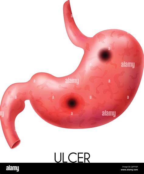 Realistic Human Internal Organ Stomach With Ulcer On White Background