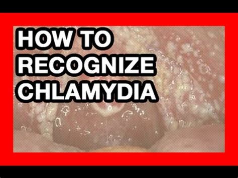 How To Recognize Chlamydia In Women And Treatment YouTube