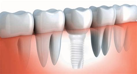 Implante Con Zirconio En Barcelona Implantosofia