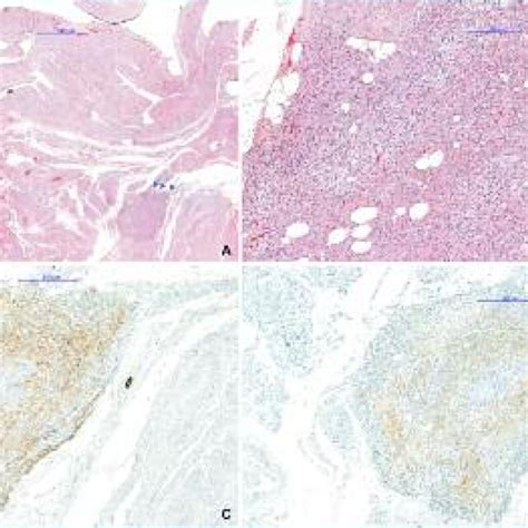 Heterotopic Adrenal Cortical Tissue A Microscopic Examination