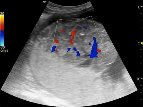 Chorioangioma Pacs