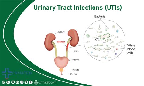 Most Common Urology Diseases