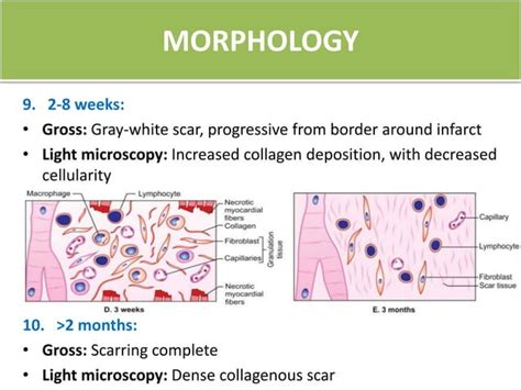 Pathogenesis And Morphological changes of Myocardial Infarction 